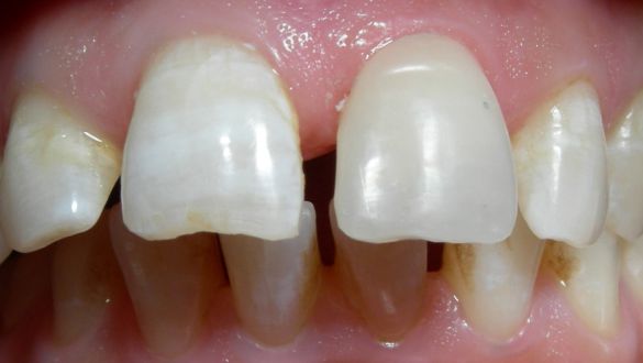 Teeth Whitening in Nadiad