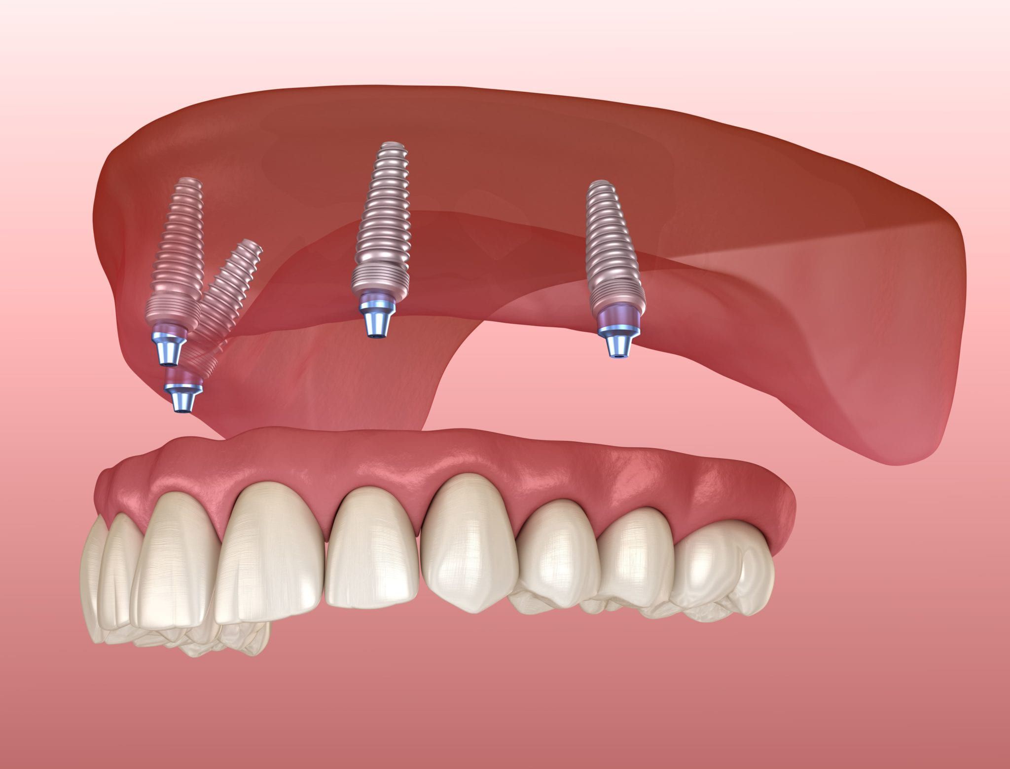 Laser Dentistry in Nadiad